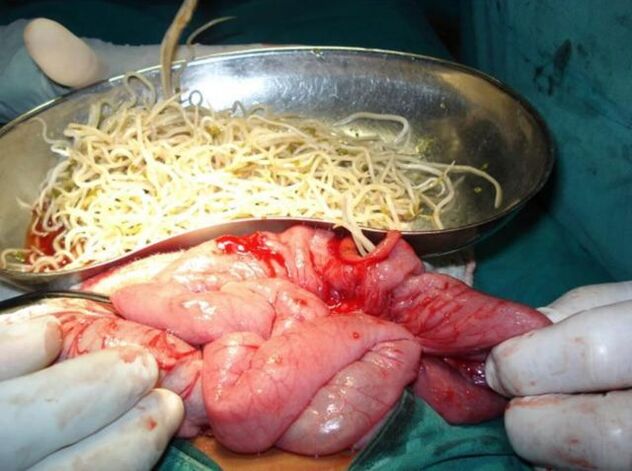 Чревни паразити